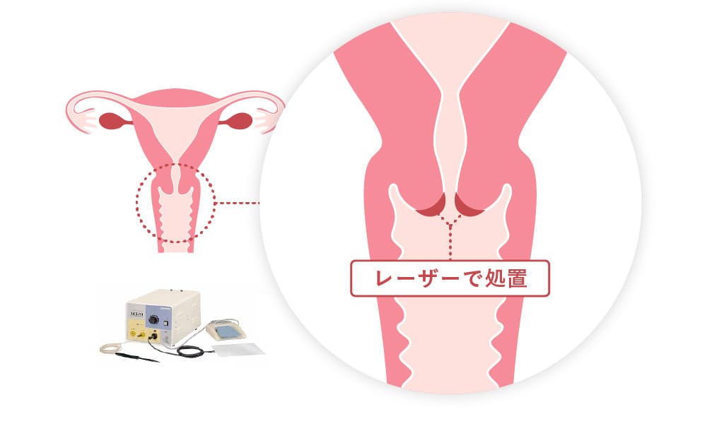 子宮頸部異形成の状態
